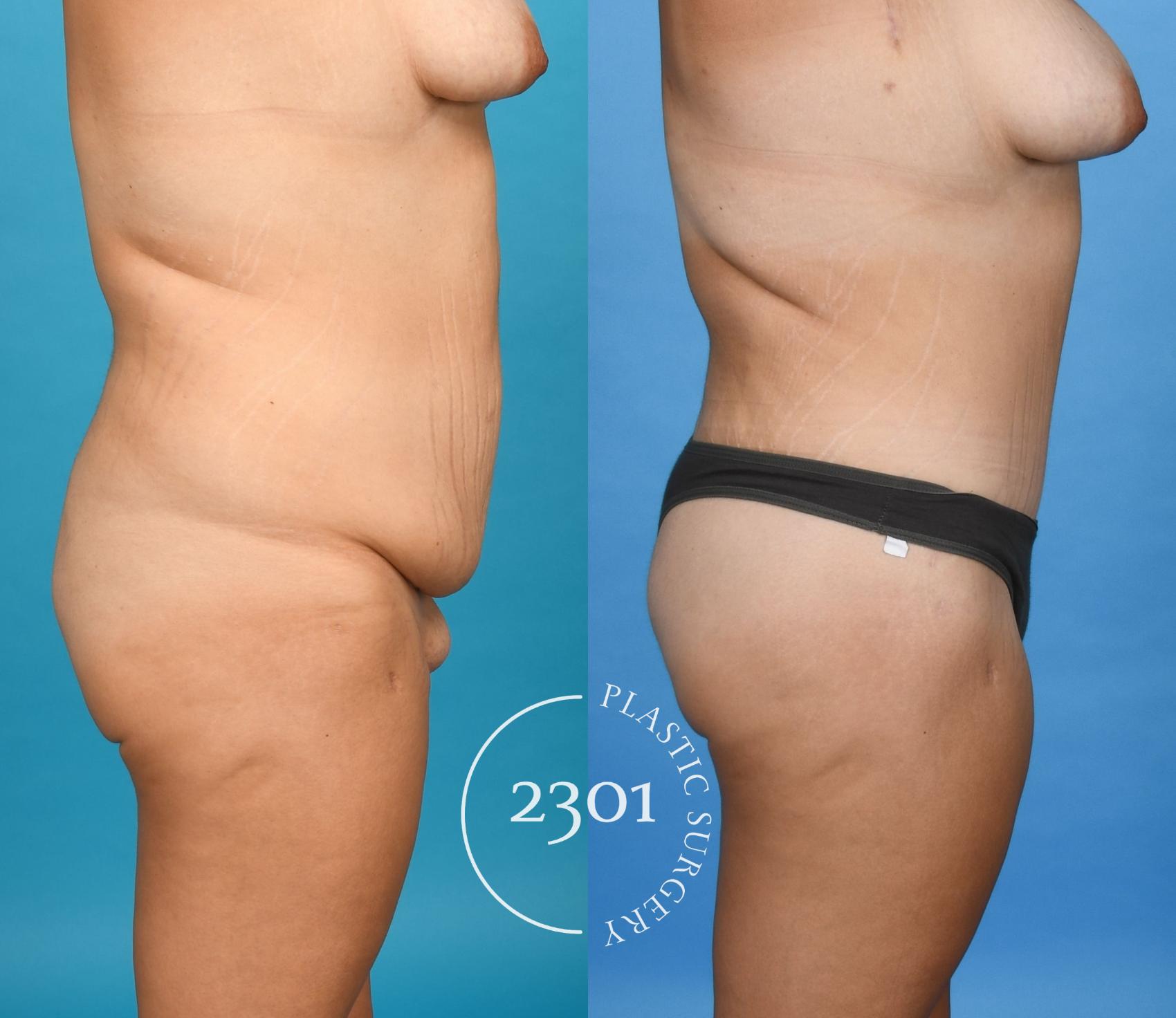 Before & After Tummy Tuck Case 745 Right Side View in Fort Worth, Plano, & Frisco, Texas