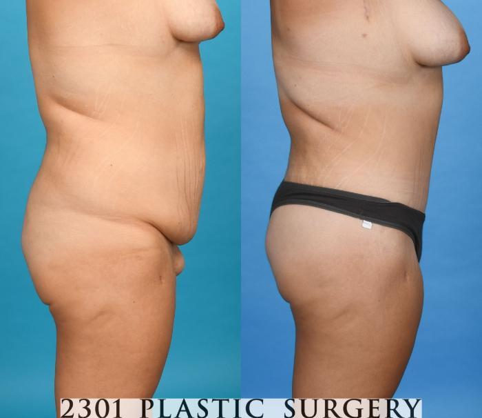 Before & After Post-Bariatric Plastic Surgery Case 745 Right Side View in Fort Worth, Plano, & Frisco, Texas