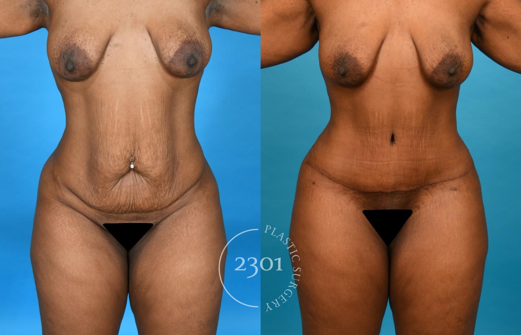 Before & After Tummy Tuck Case 751 Front View in Fort Worth, Plano, & Frisco, Texas