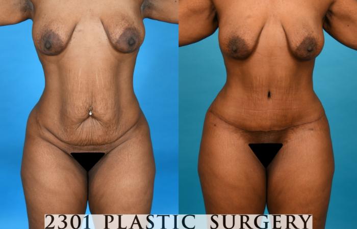 Before & After Post-Bariatric Plastic Surgery Case 751 Front View in Fort Worth, Plano, & Frisco, Texas