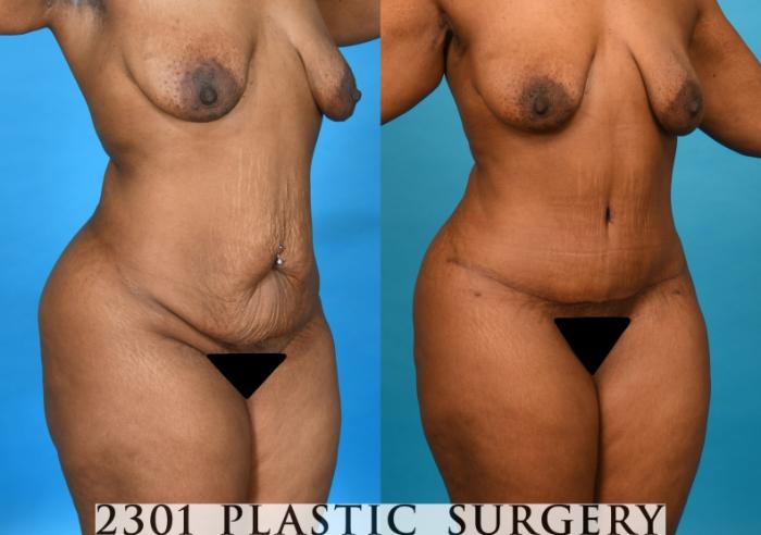 Before & After Tummy Tuck Case 751 Right Oblique View in Fort Worth, Plano, & Frisco, Texas