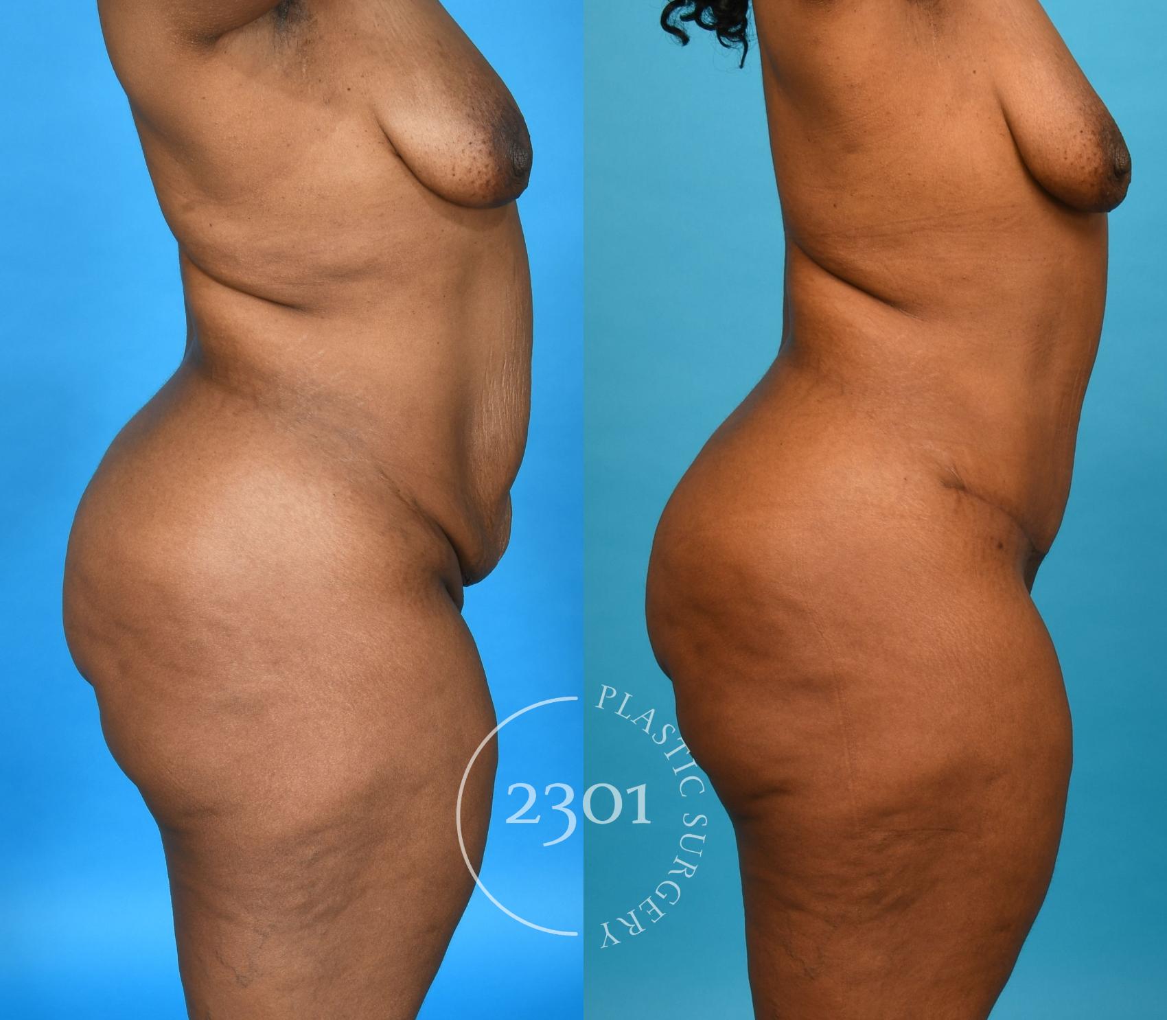 Before & After Post-Bariatric Plastic Surgery Case 751 Right Side View in Fort Worth, Plano, & Frisco, Texas