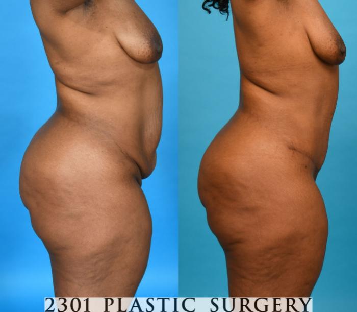 Before & After Tummy Tuck Case 751 Right Side View in Fort Worth, Plano, & Frisco, Texas