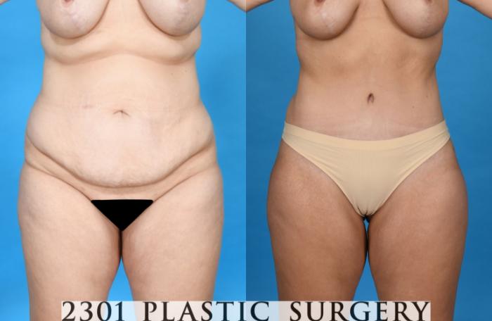 Before & After Tummy Tuck Case 752 Front View in Fort Worth, Plano, & Frisco, Texas