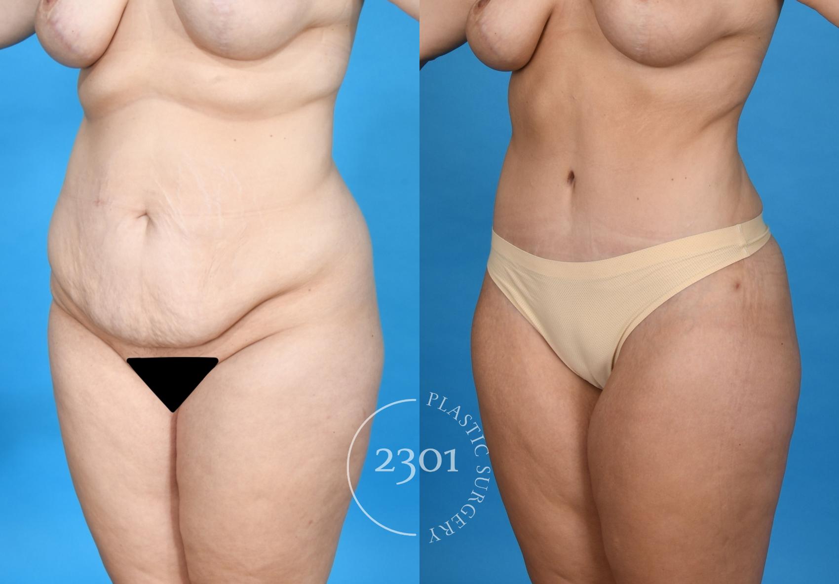 Before & After Tummy Tuck Case 752 Left Oblique View in Fort Worth, Plano, & Frisco, Texas