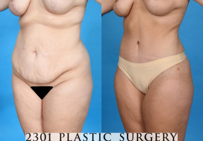 Before & After Tummy Tuck Case 752 Left Oblique View in Fort Worth, Plano, & Frisco, Texas