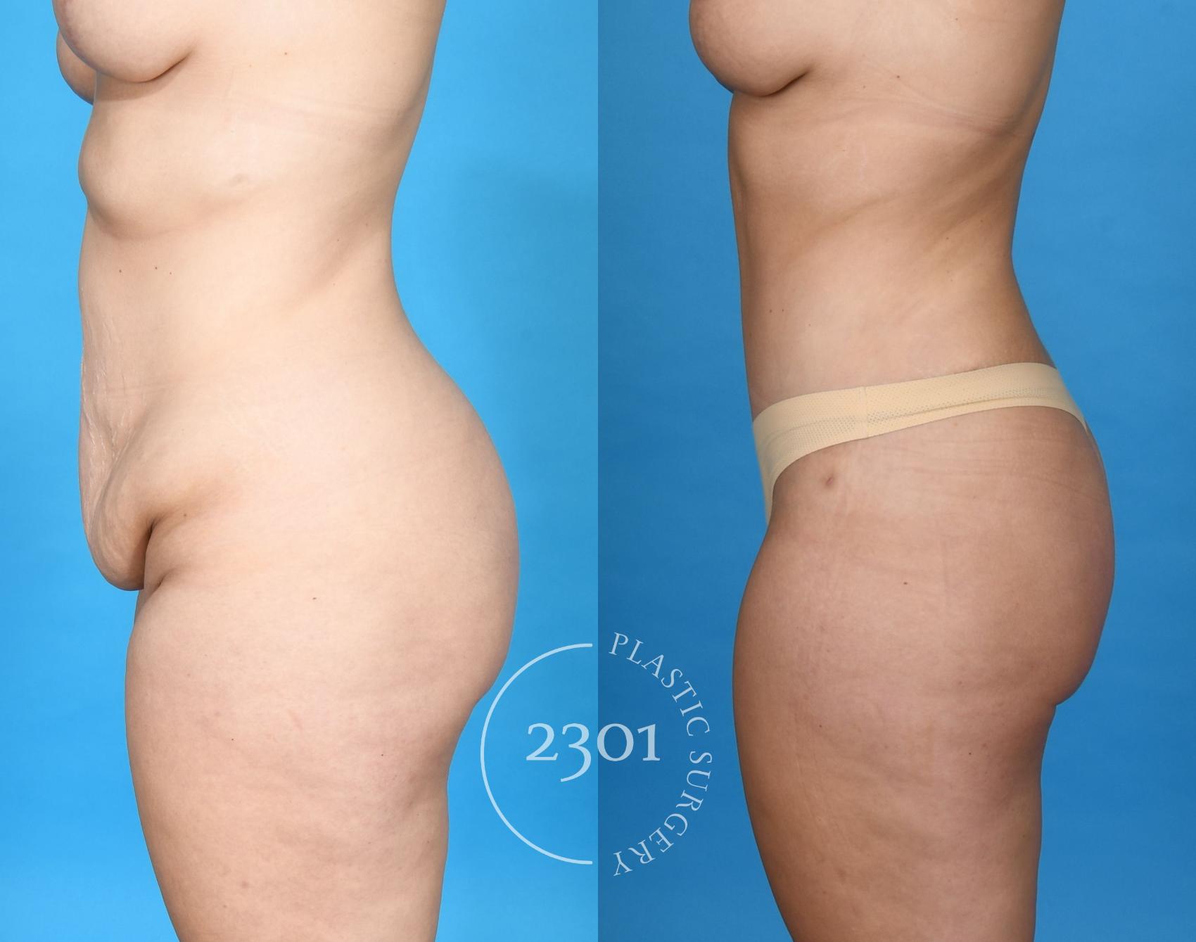 Before & After Tummy Tuck Case 752 Left Side View in Fort Worth, Plano, & Frisco, Texas
