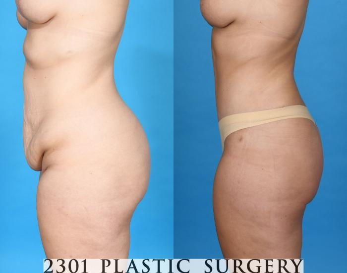 Before & After Tummy Tuck Case 752 Left Side View in Fort Worth, Plano, & Frisco, Texas