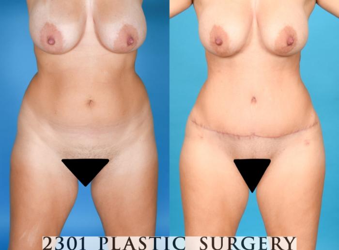 Before & After Tummy Tuck Case 753 Front View in Fort Worth, Plano, & Frisco, Texas