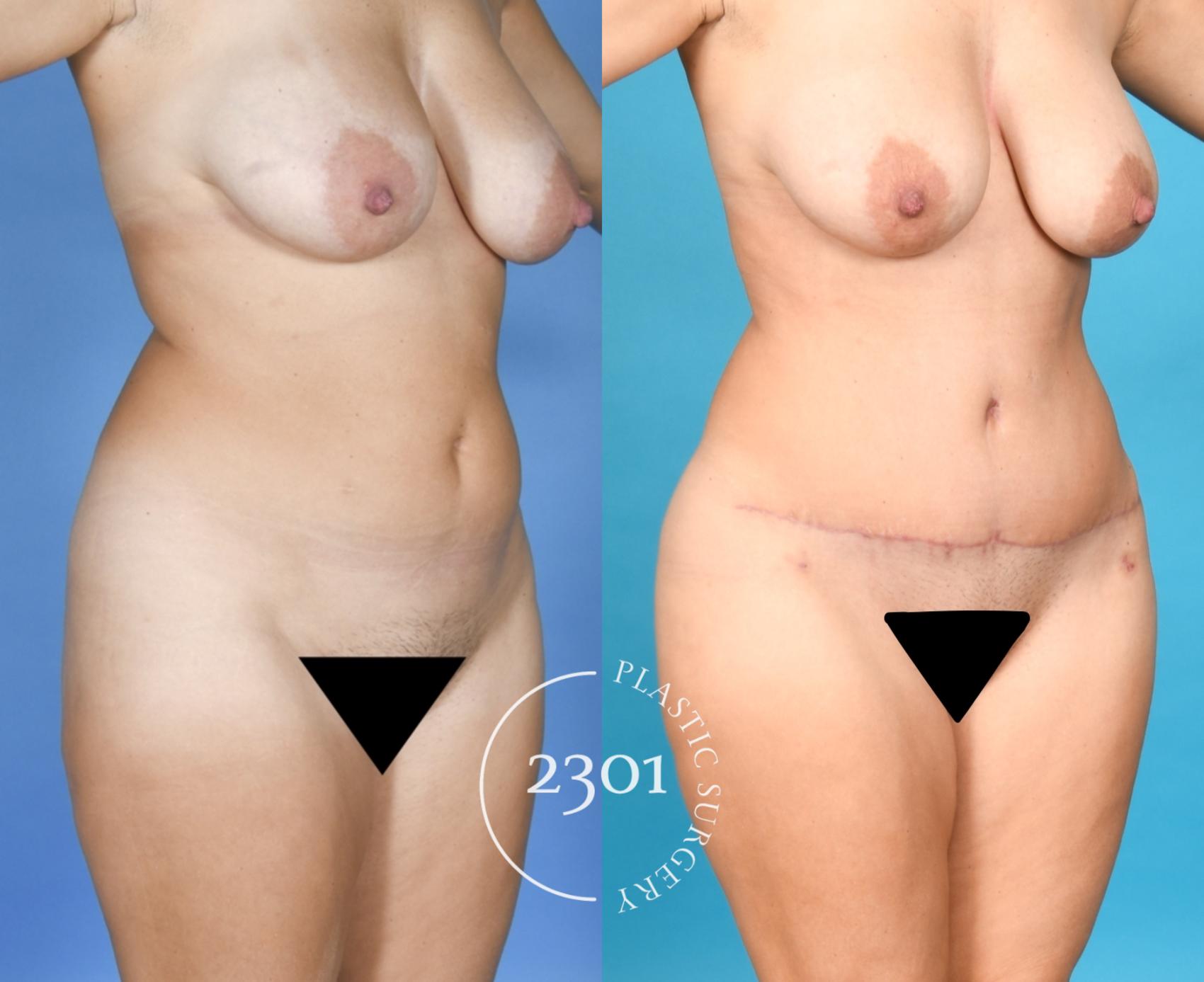 Before & After Tummy Tuck Case 753 Right Oblique View in Fort Worth, Plano, & Frisco, Texas