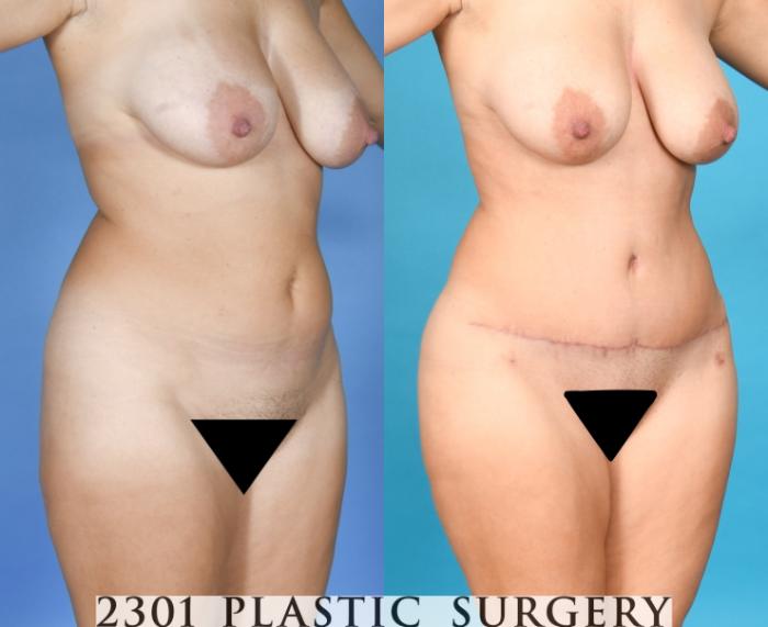 Before & After Tummy Tuck Case 753 Right Oblique View in Fort Worth, Plano, & Frisco, Texas
