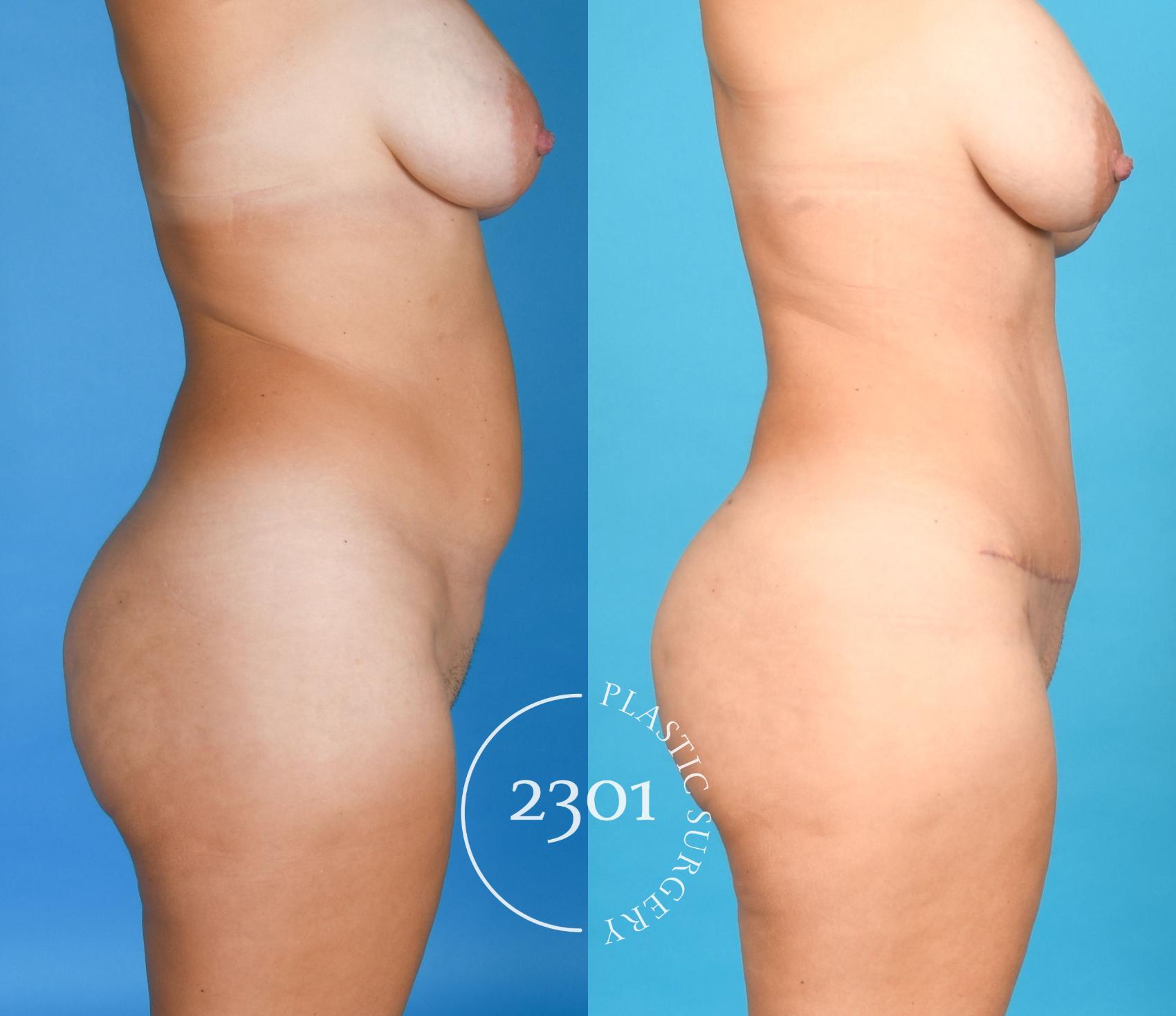 Before & After Tummy Tuck Case 753 Right Side View in Fort Worth, Plano, & Frisco, Texas