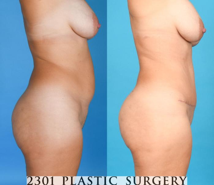 Before & After Tummy Tuck Case 753 Right Side View in Fort Worth, Plano, & Frisco, Texas