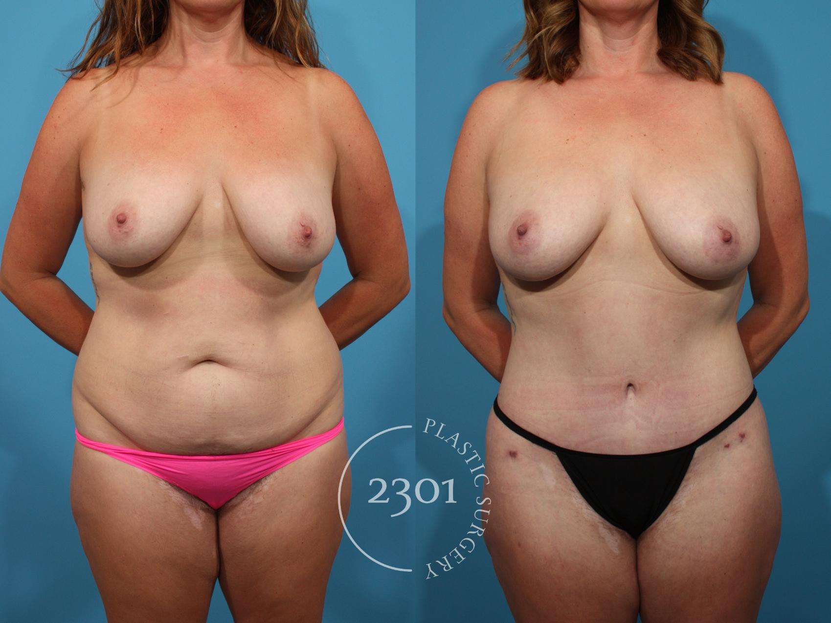 Before & After Liposuction Case 769 Front View in Fort Worth, Plano, & Frisco, Texas