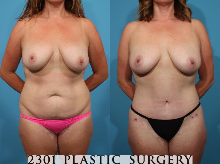 Before & After Liposuction Case 769 Front View in Fort Worth, Plano, & Frisco, Texas