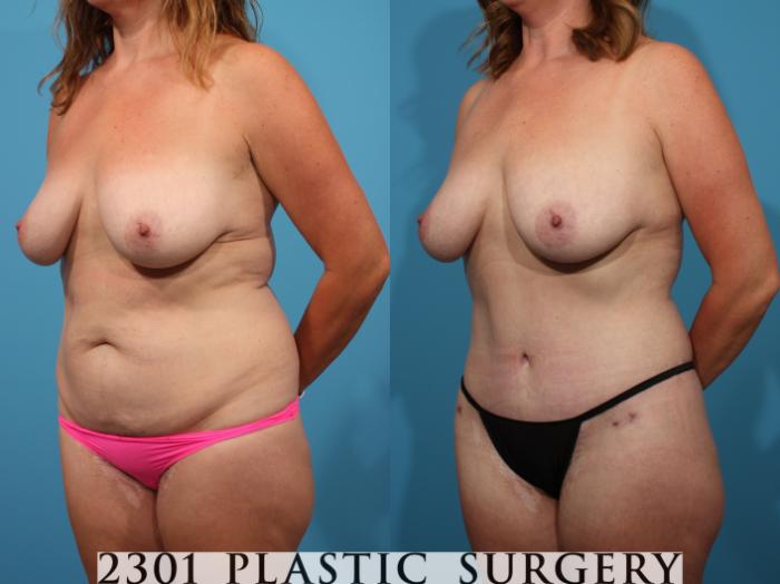 Before & After Liposuction Case 769 Left Oblique View in Fort Worth, Plano, & Frisco, Texas