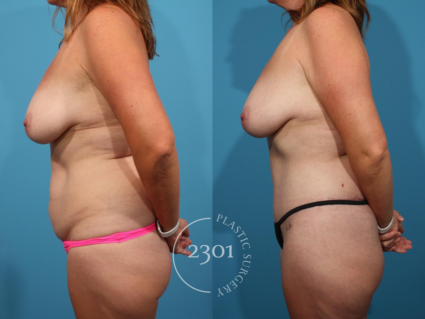 Before & After Liposuction Case 769 Left Side View in Fort Worth, Plano, & Frisco, Texas