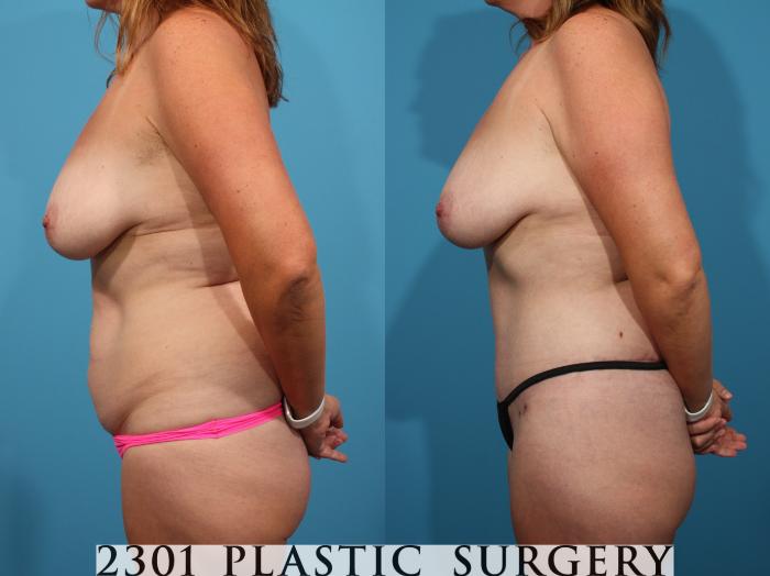 Before & After Liposuction Case 769 Left Side View in Fort Worth, Plano, & Frisco, Texas