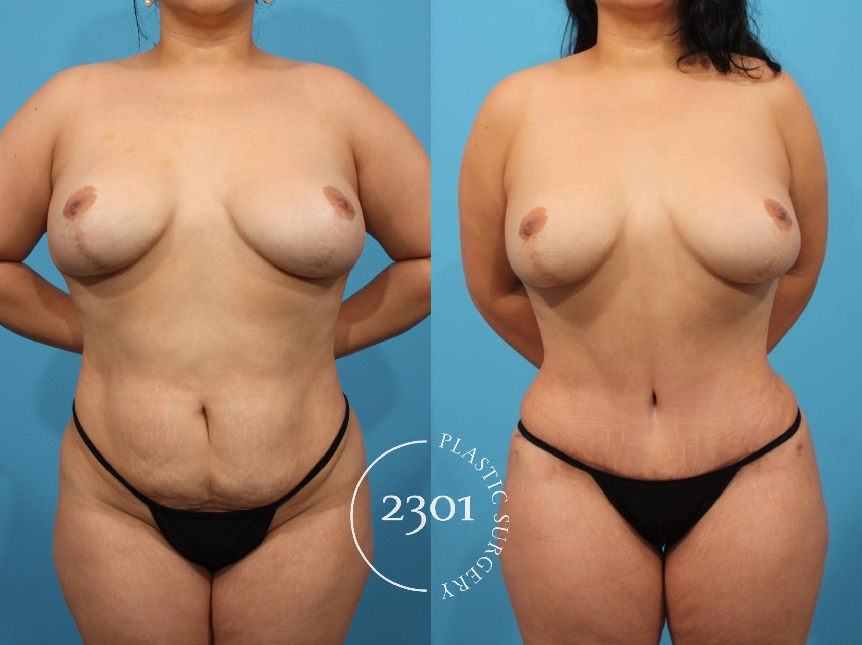 Before & After Tummy Tuck Case 792 Front View in Fort Worth, Plano, & Frisco, Texas