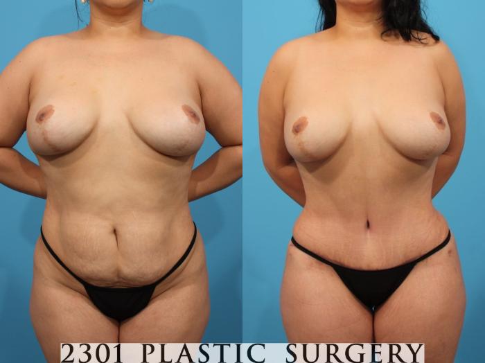 Before & After Tummy Tuck Case 792 Front View in Fort Worth, Plano, & Frisco, Texas