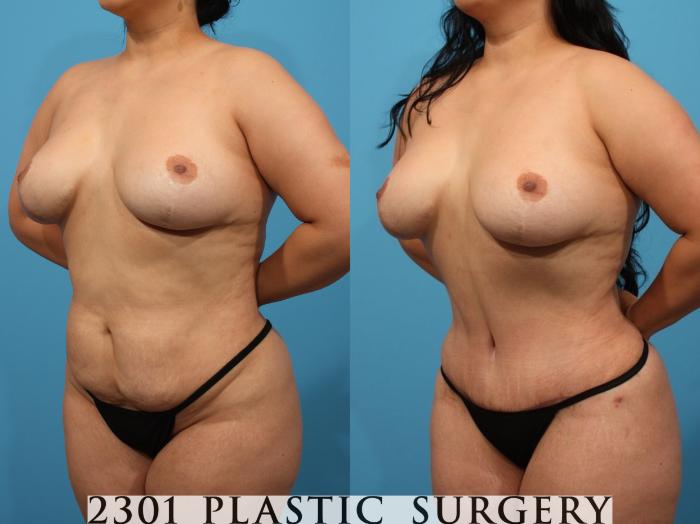 Before & After Tummy Tuck Case 792 Left Oblique View in Fort Worth, Plano, & Frisco, Texas