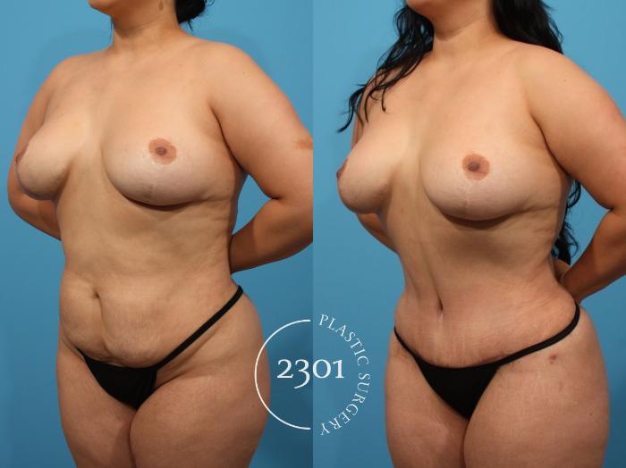 Before & After Tummy Tuck Case 792 Left Oblique View in Fort Worth, Plano, & Frisco, Texas