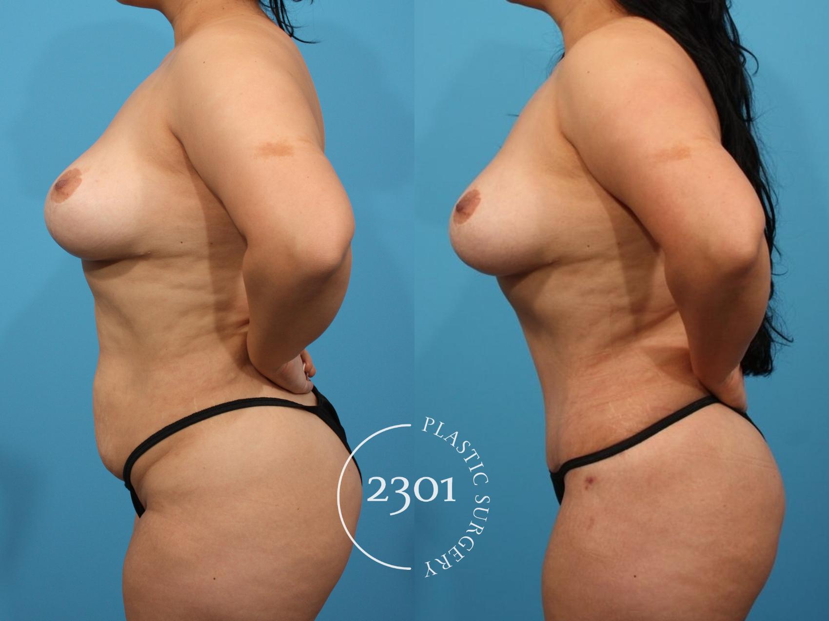 Before & After Tummy Tuck Case 792 Left Side View in Fort Worth, Plano, & Frisco, Texas