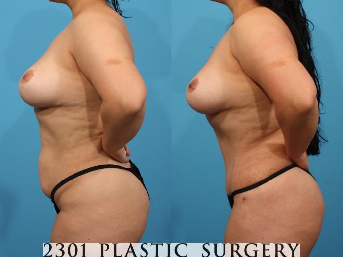 Before & After Tummy Tuck Case 792 Left Side View in Fort Worth, Plano, & Frisco, Texas