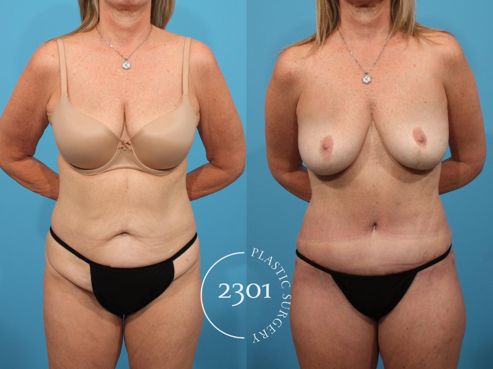 Before & After Tummy Tuck Case 800 Front View in Fort Worth, Plano, & Frisco, Texas