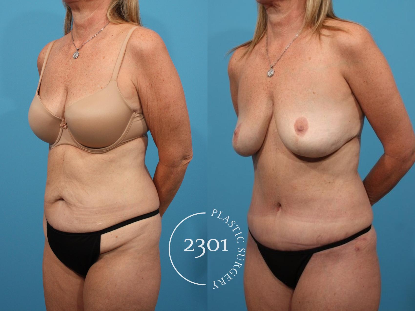 Before & After Tummy Tuck Case 800 Left Oblique View in Fort Worth, Plano, & Frisco, Texas