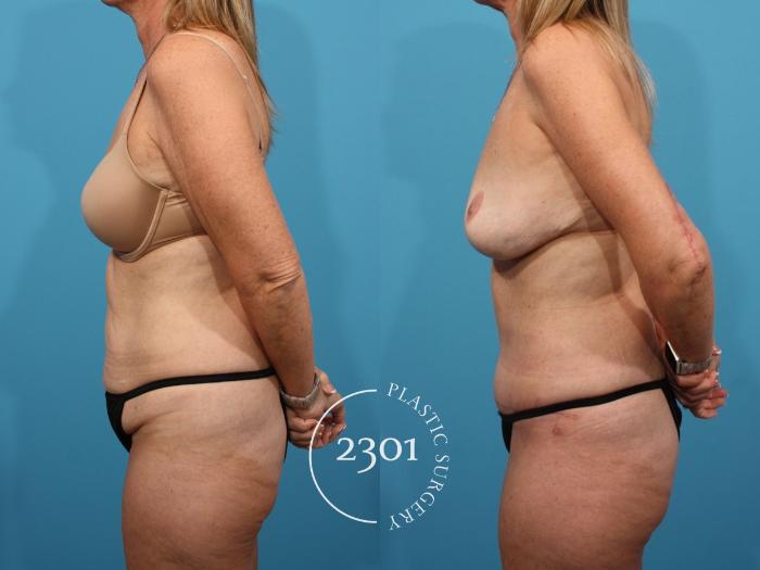 Before & After Tummy Tuck Case 800 Left Side View in Fort Worth, Plano, & Frisco, Texas