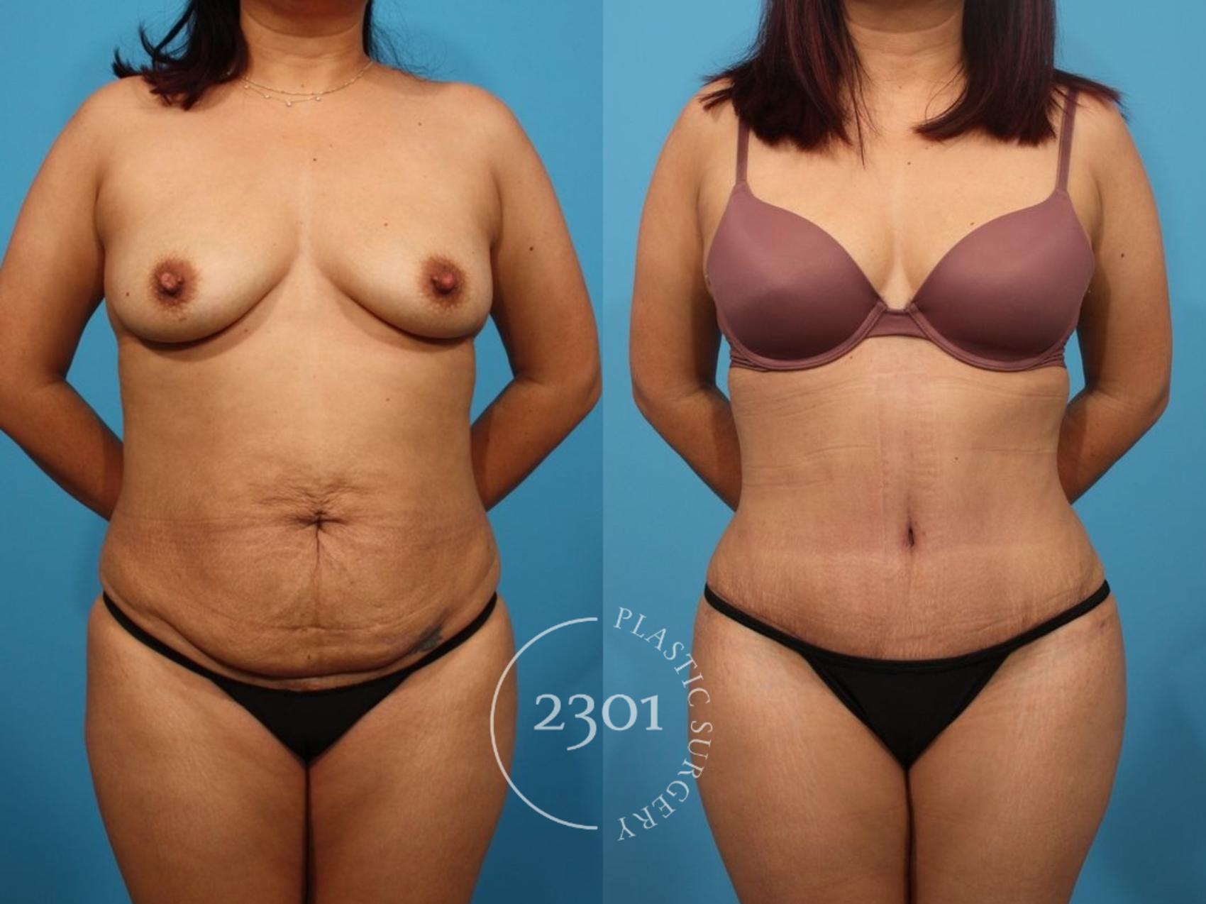 Before & After Tummy Tuck Case 809 Front View in Fort Worth, Plano, & Frisco, Texas