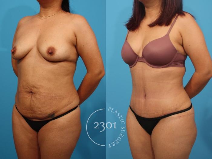 Before & After Tummy Tuck Case 809 Left Oblique View in Fort Worth, Plano, & Frisco, Texas