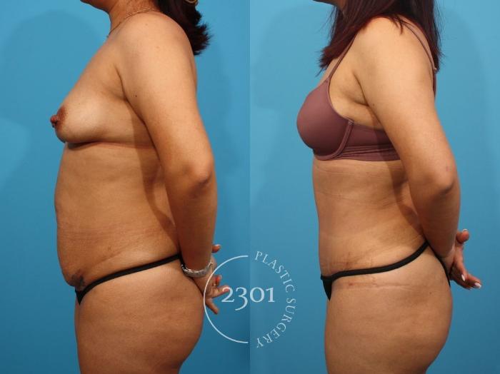 Before & After Tummy Tuck Case 809 Left Side View in Fort Worth, Plano, & Frisco, Texas