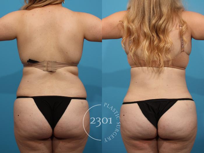 Before & After Tummy Tuck Case 818 Back View in Fort Worth, Plano, & Frisco, Texas