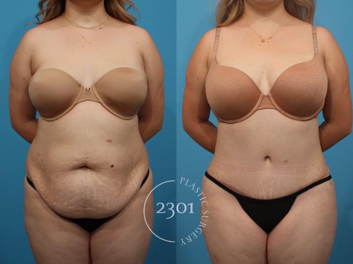 Before & After Tummy Tuck Case 818 Front View in Fort Worth, Plano, & Frisco, Texas