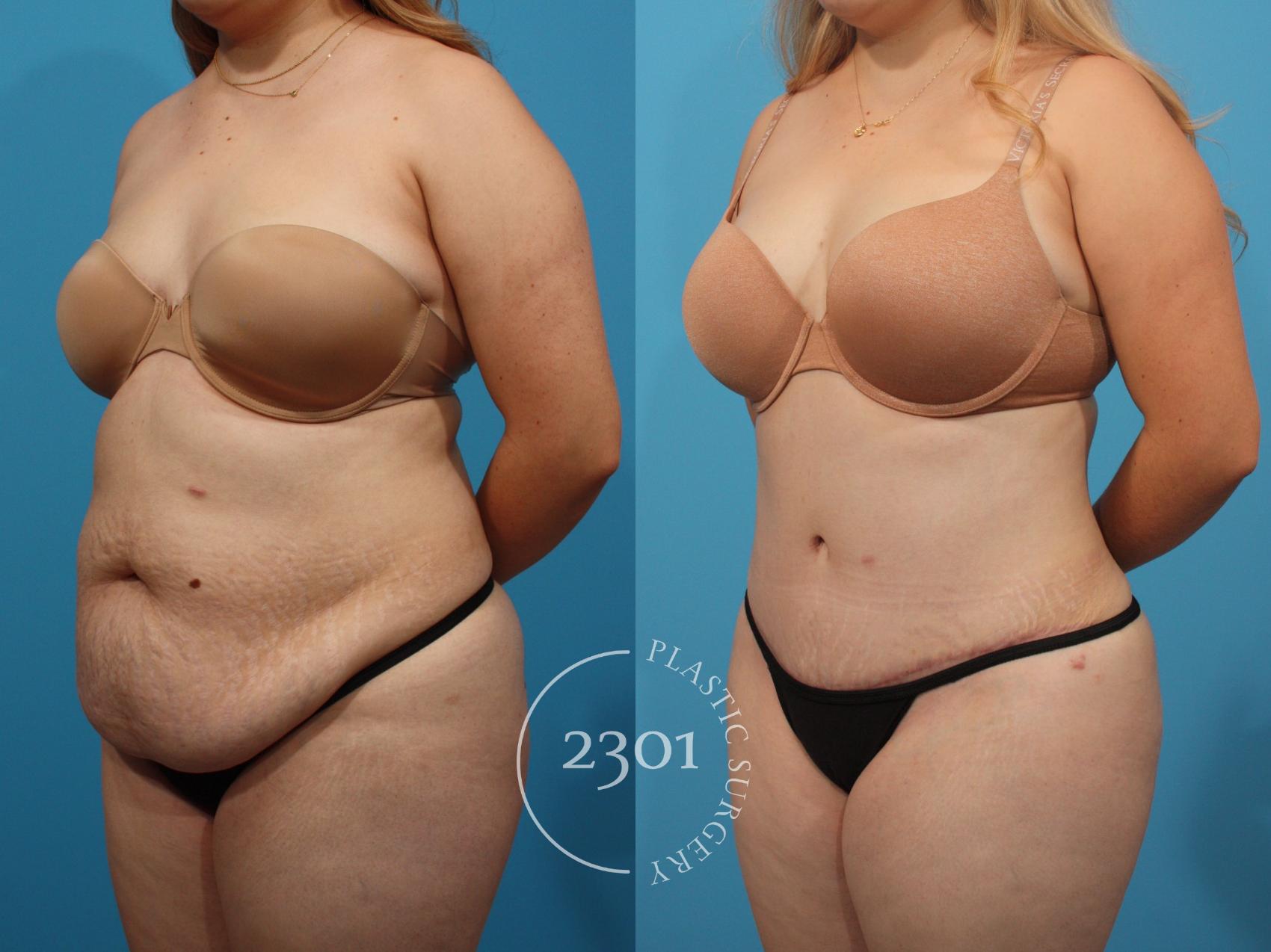 Before & After Tummy Tuck Case 818 Left Oblique View in Fort Worth, Plano, & Frisco, Texas