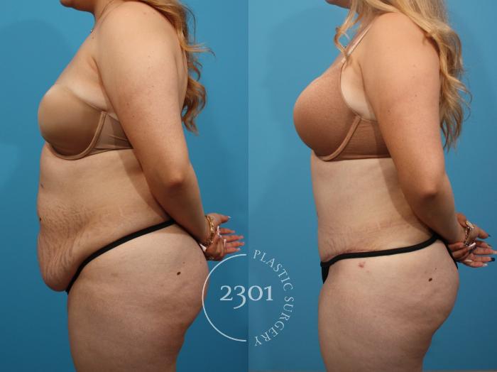 Before & After Tummy Tuck Case 818 Left Side View in Fort Worth, Plano, & Frisco, Texas