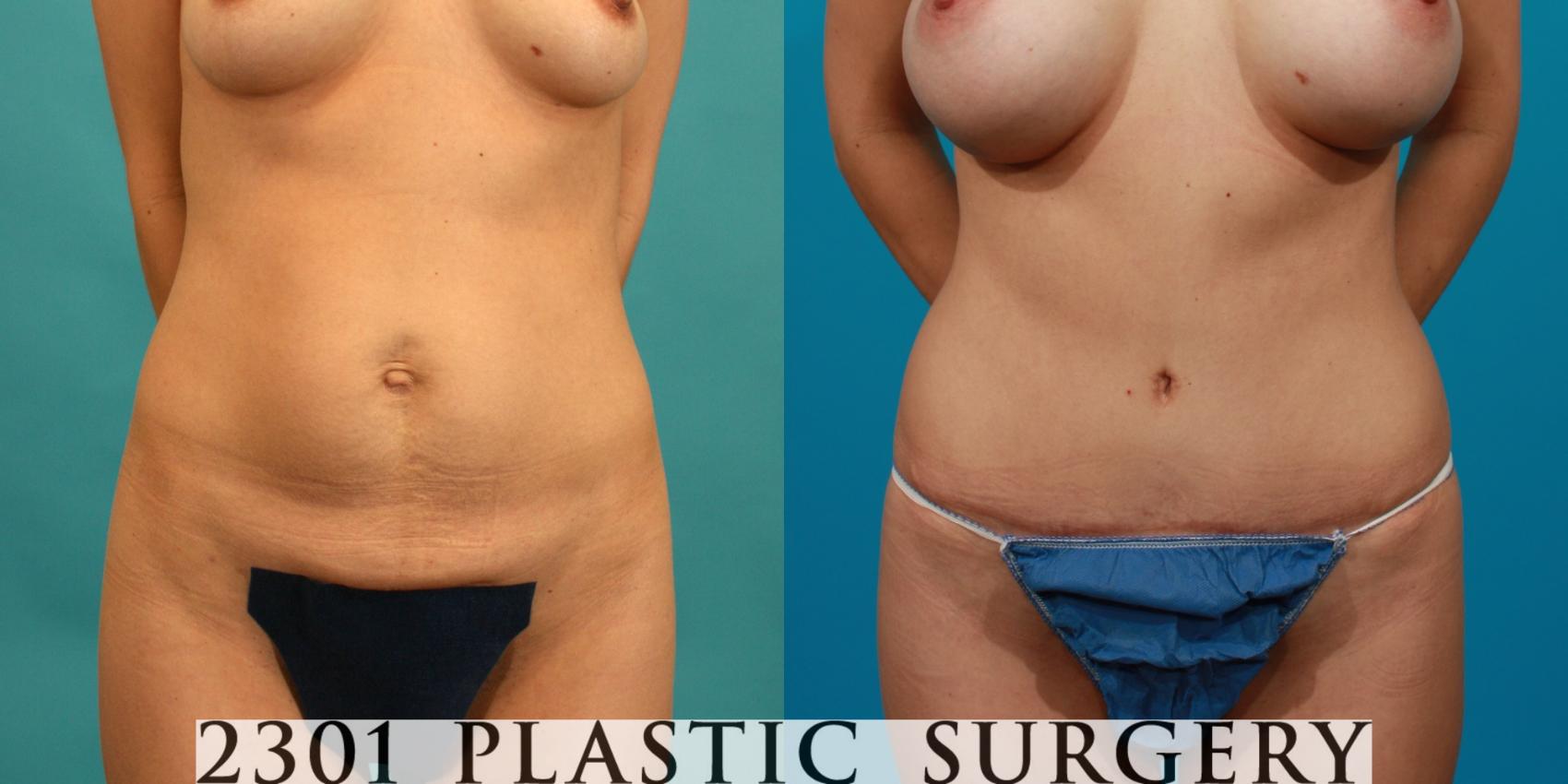 Before & After Tummy Tuck Case 82 View #1 View in Fort Worth, Plano, & Frisco, Texas