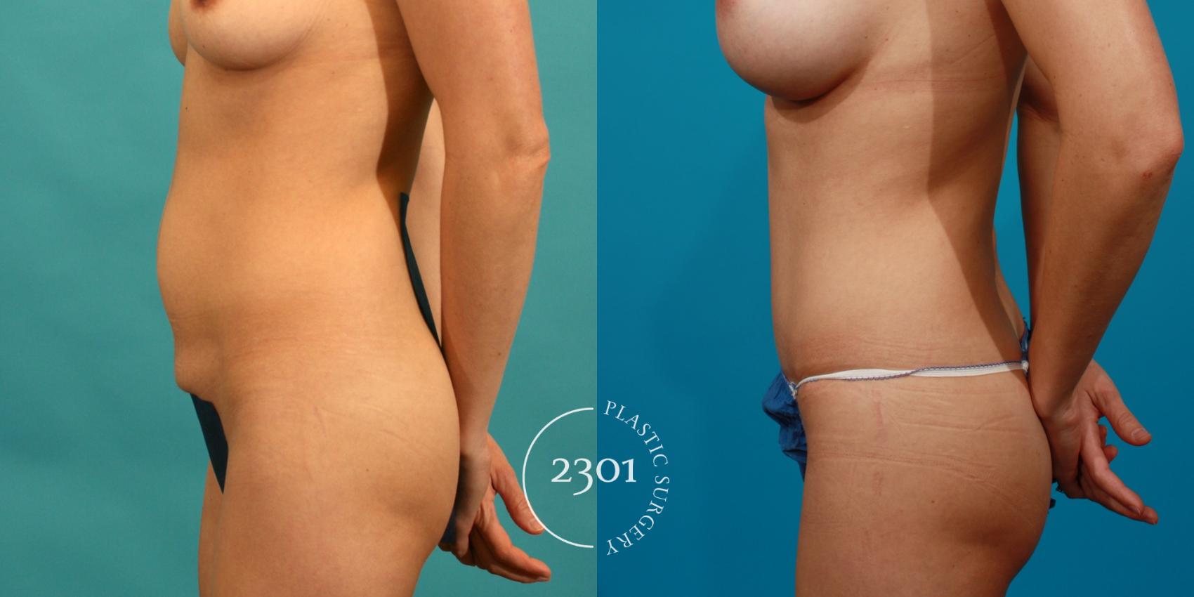 Before & After Tummy Tuck Case 82 View #2 View in Fort Worth, Plano, & Frisco, Texas