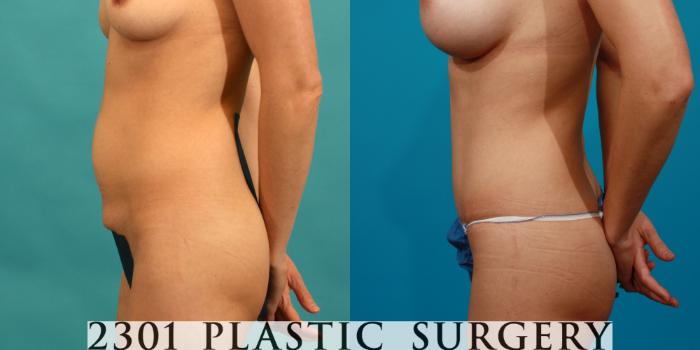 Before & After Tummy Tuck Case 82 View #2 View in Fort Worth, Plano, & Frisco, Texas