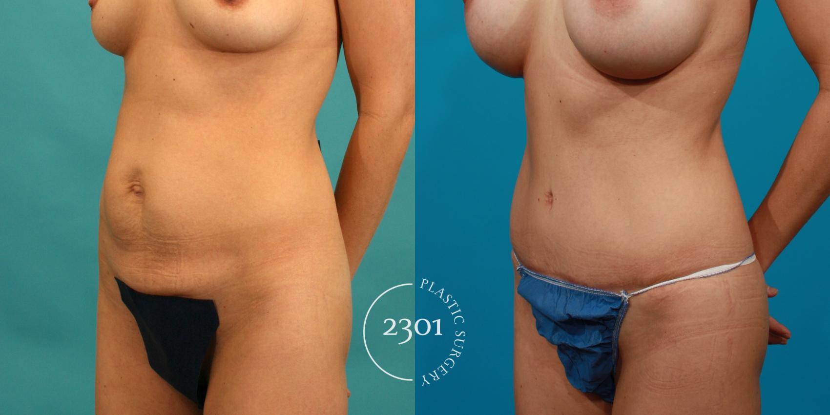 Before & After Tummy Tuck Case 82 View #3 View in Fort Worth, Plano, & Frisco, Texas