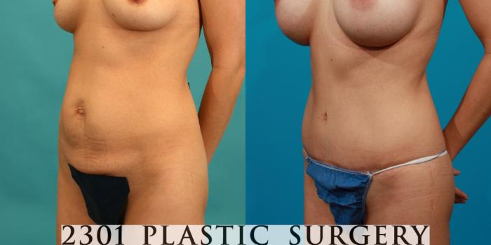Before & After Tummy Tuck Case 82 View #3 View in Fort Worth, Plano, & Frisco, Texas