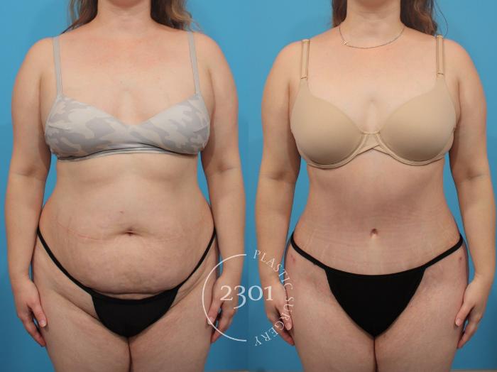 Before & After Tummy Tuck Case 838 Front View in Fort Worth, Plano, & Frisco, Texas