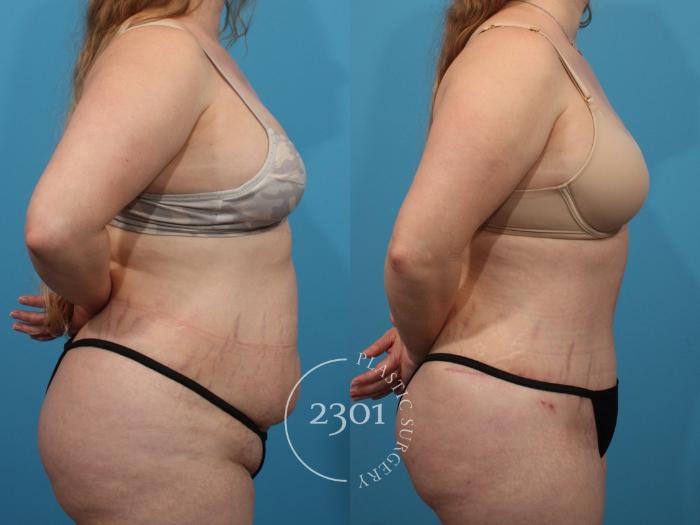 Before & After Tummy Tuck Case 838 Left Side View in Fort Worth, Plano, & Frisco, Texas