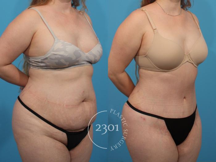 Before & After Tummy Tuck Case 838 Right Oblique View in Fort Worth, Plano, & Frisco, Texas