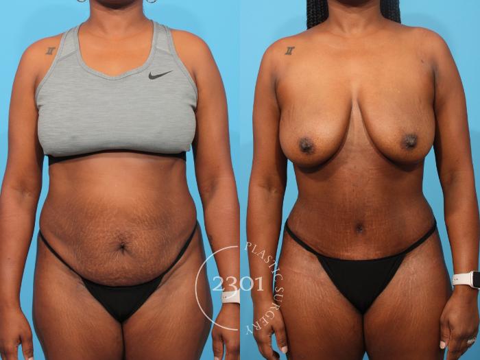 Before & After Liposuction - Abdomen Case 849 Front View in Fort Worth, Plano, & Frisco, Texas