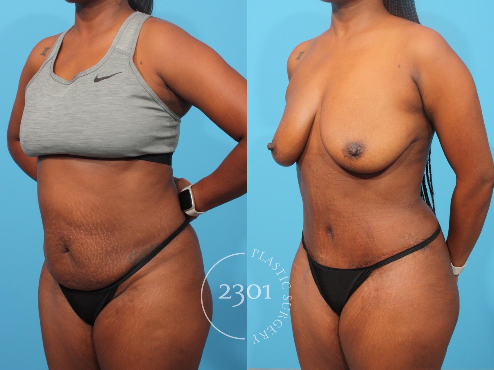 Before & After Tummy Tuck Case 849 Left Oblique View in Fort Worth, Plano, & Frisco, Texas