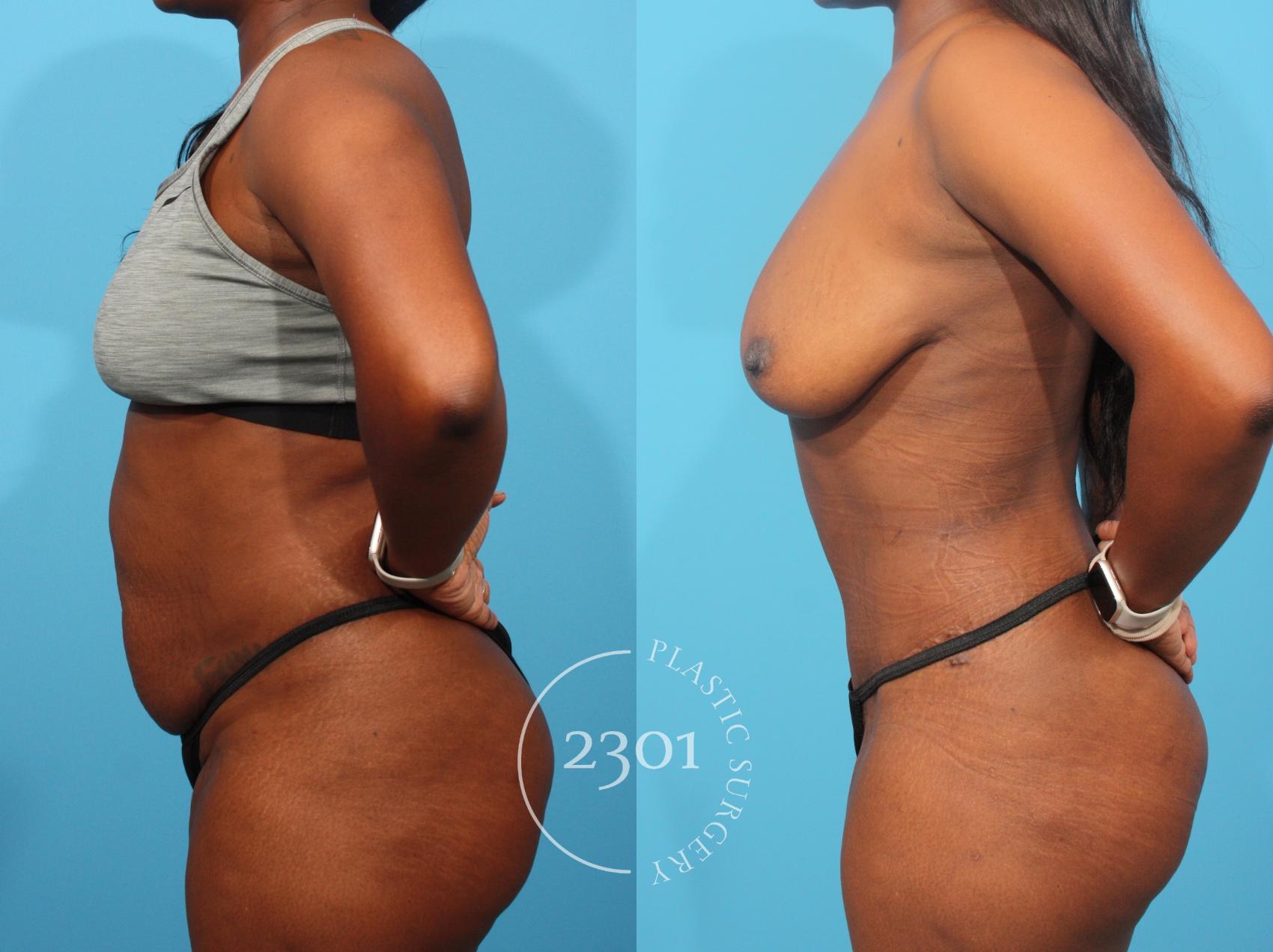 Before & After Tummy Tuck Case 849 Left Side View in Fort Worth, Plano, & Frisco, Texas
