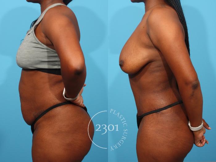 Before & After Tummy Tuck Case 849 Left Side View in Fort Worth, Plano, & Frisco, Texas